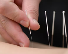 Acupuncturist practicing acupuncture at Brook Green Clinic Hammersmith